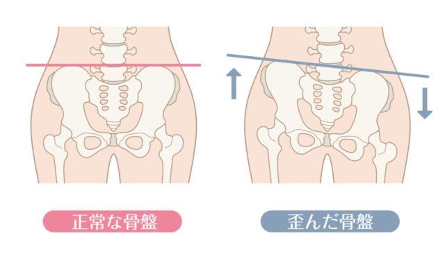 【骨盤のゆがみも骨盤ストレッチも全てウソ】